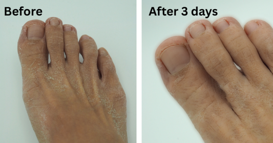 Food Allergies and Eczema