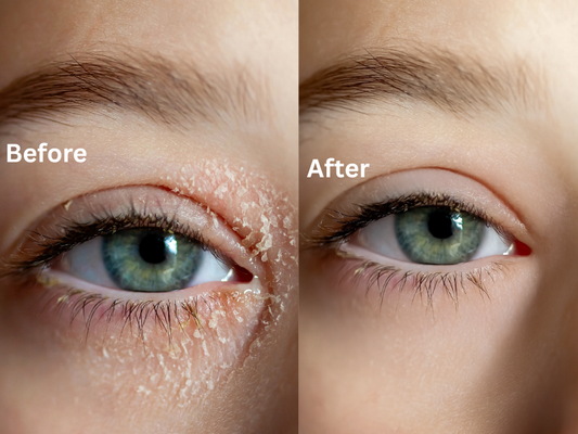 Atopic Dermatitis & Genetics: Is Eczema Genetic or Environmental?