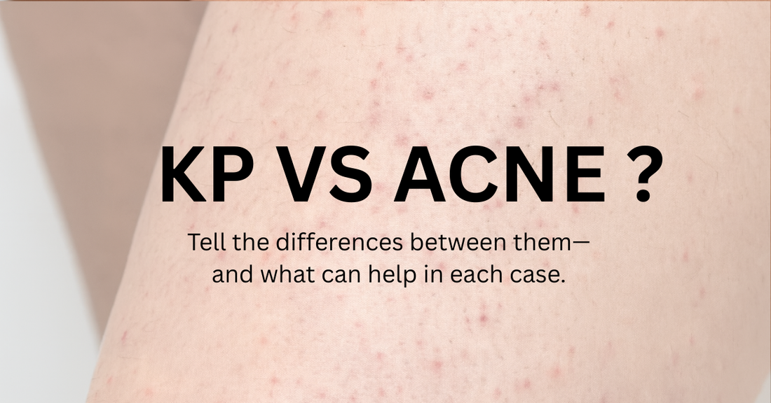 KP vs. Acne: Why People Confuse Them- and How to Finally Tell the Difference