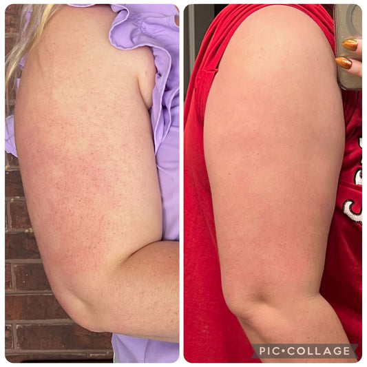 Does Keratosis Pilaris (KP) Go Away With Age?