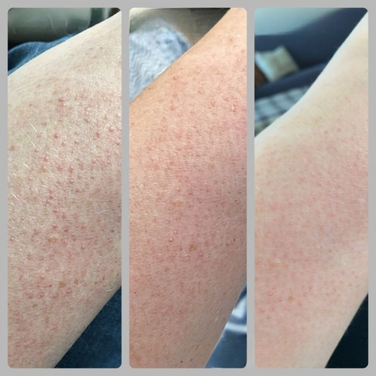 Keratosis Pilaris Symptoms: How to Know if You Have Chicken Skin