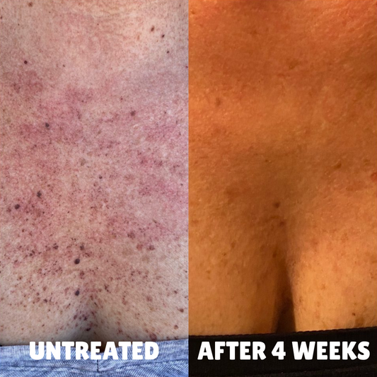 Best Sunscreens for Hyperpigmentation-Prone Skin