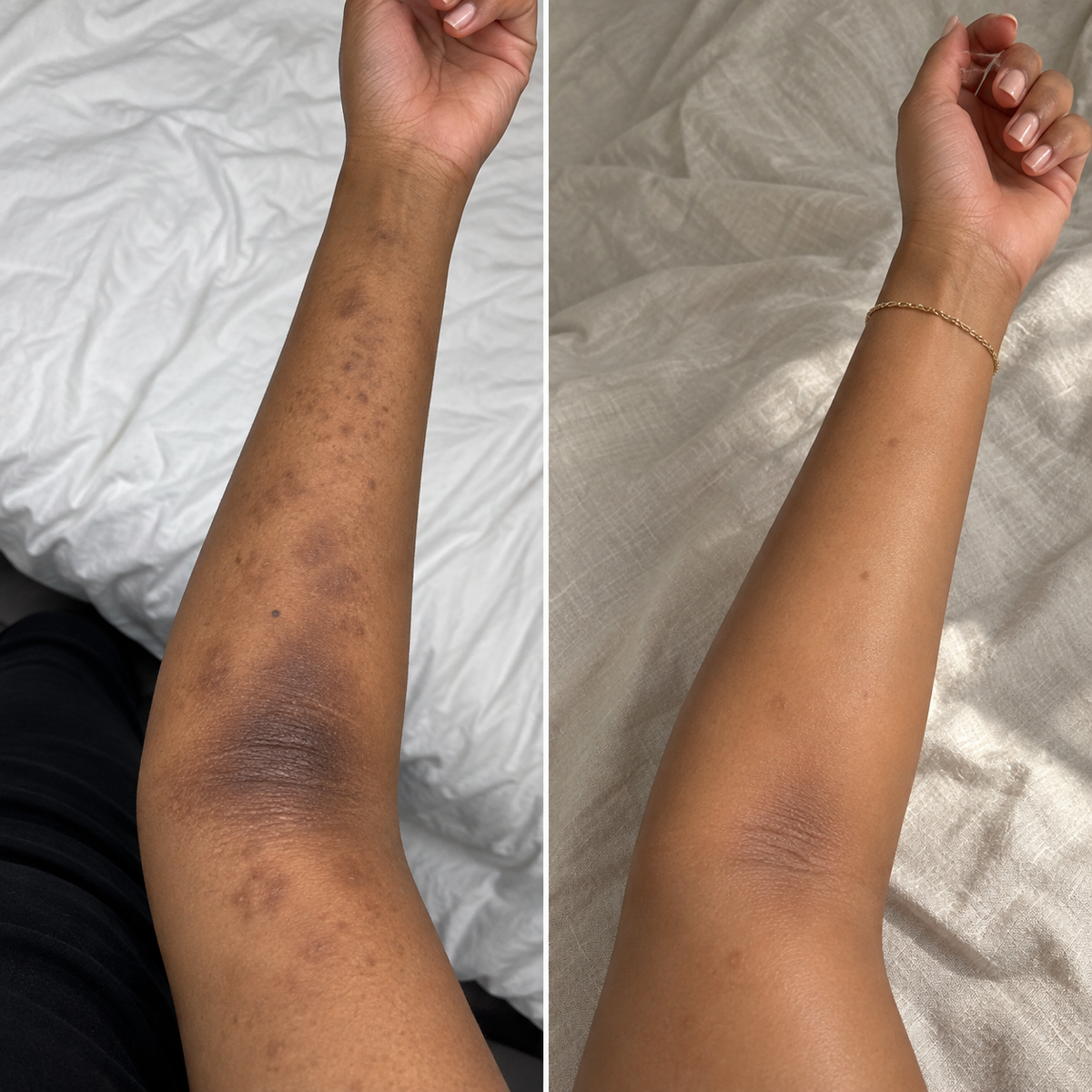 Before and after showing visibly faded dark patches on the arm after 14 days