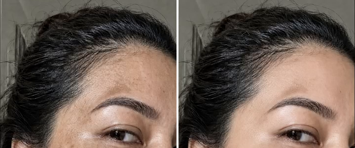 Melasma after pregnancy beside the same cheek visibly lighter