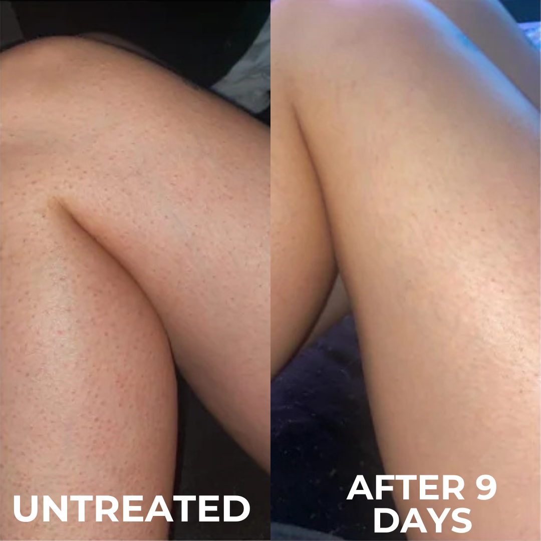 Advanced Triple-Acid Complex for Keratosis Pilaris, showing untreated skin and results after 9 days of use.