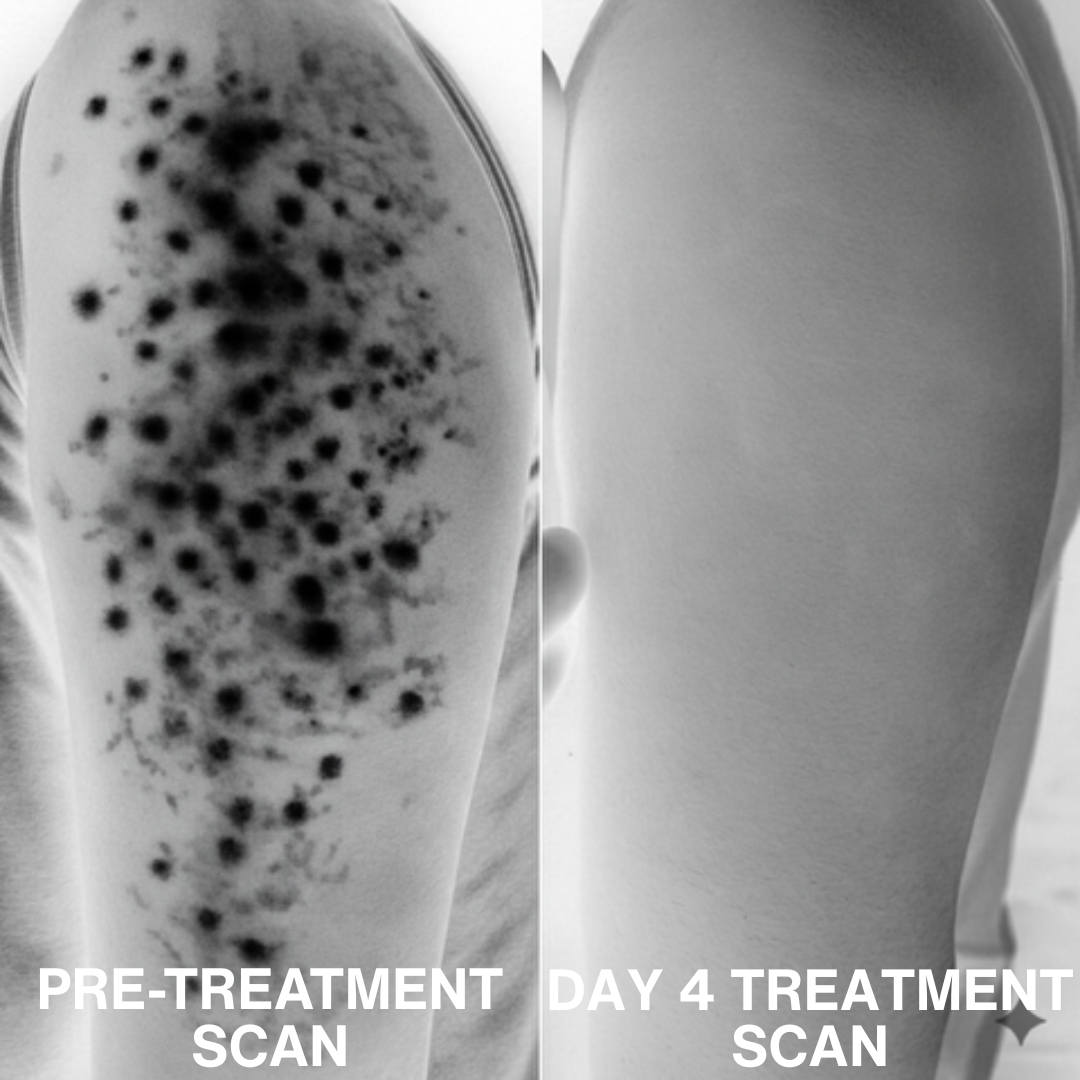 Advanced Triple-Acid Complex for Keratosis Pilaris, showing skin improvement from pre-treatment to day 4 treatment scan.