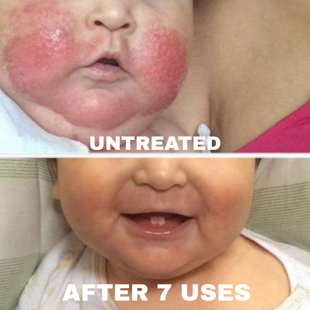 Advanced Barrier Repair Complex for Eczema, showing skin improvement after treatment on a child's face.