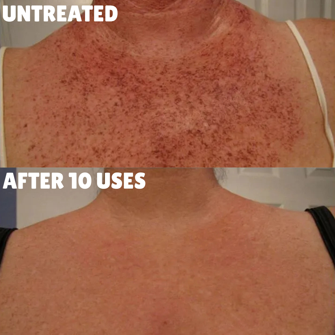 Advanced Triple-Acid Complex for Hyperpigmentation