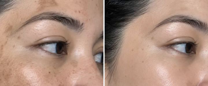 Melasma across a cheek beside the same cheek clear and even