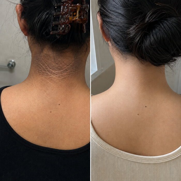 Before and after: dark velvety pigmentation across the back of the neck, cleared and even after treatment