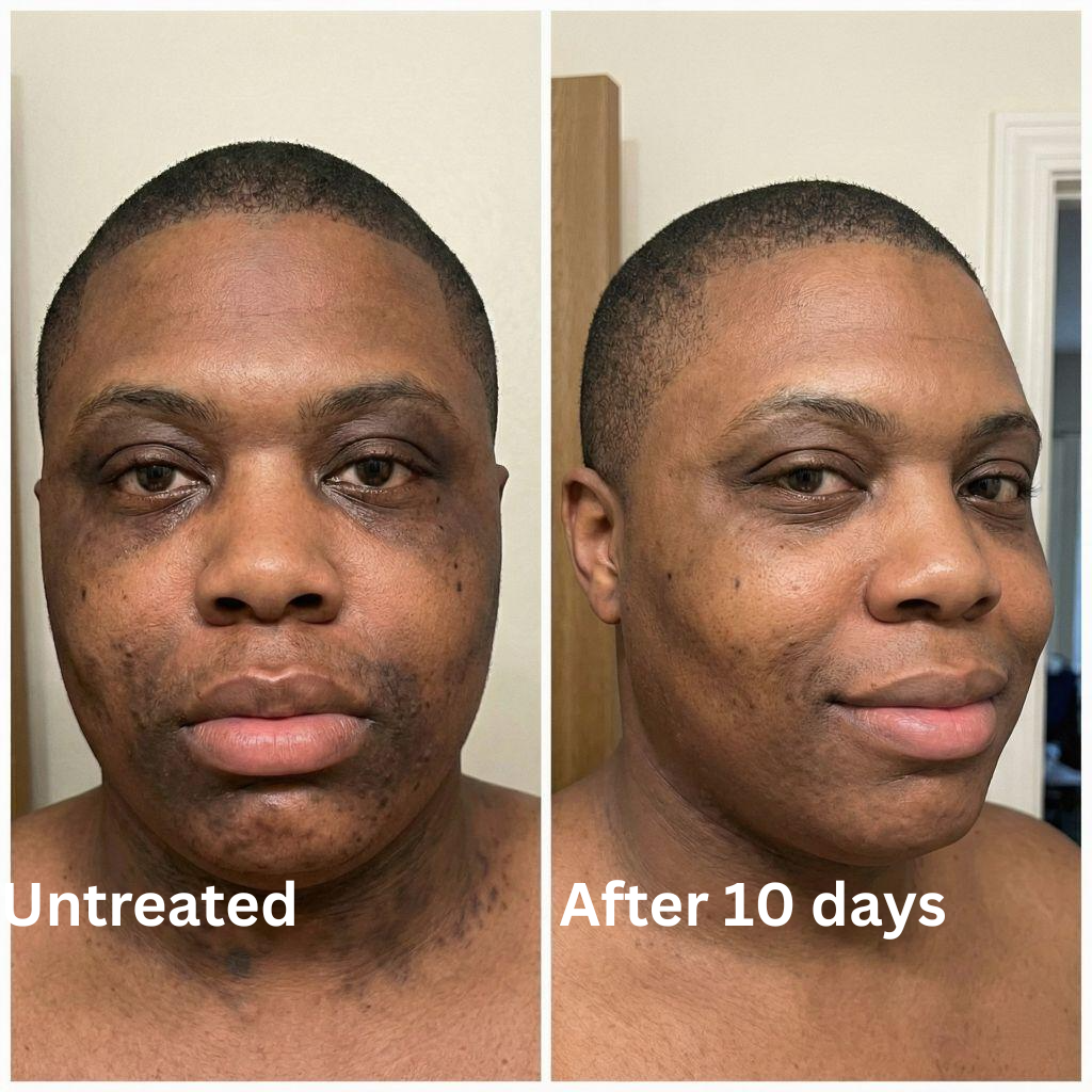 Advanced Triple-Acid Complex for Hyperpigmentation (Copy)
