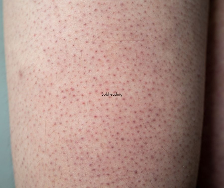 Close-up of keratosis pilaris on skin
