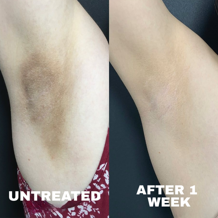 Before and after: underarm pigmentation visibly lighter after one week