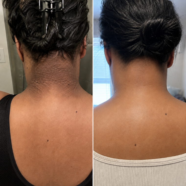 Before and after: thickened, dark velvety pigmentation across the back of the neck, smooth and even after treatment