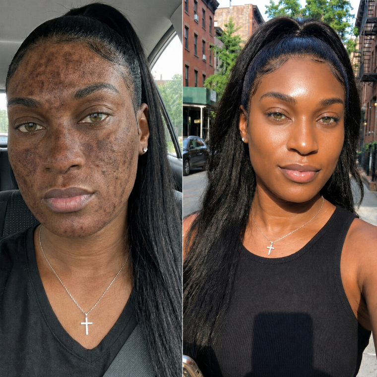 Imani's forehead and cheeks before and after, melasma faded