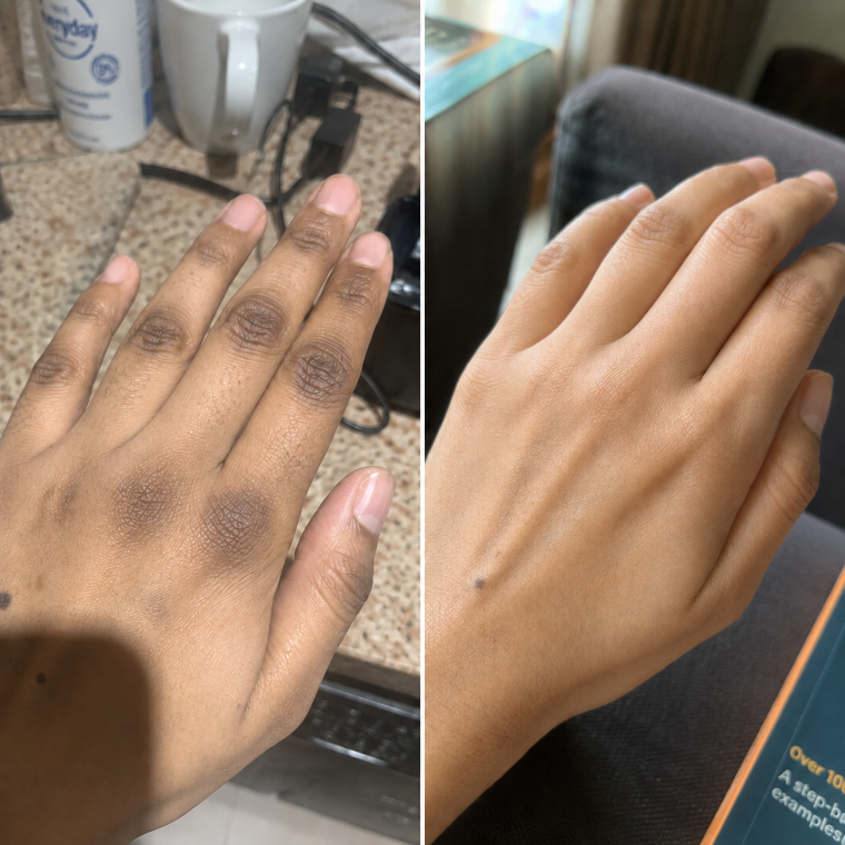 Michelle's hands before and after, dark knuckle patches evened out