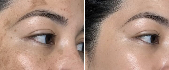 Brown patches across the cheek and temple, then the same cheek clear and even after 30 days