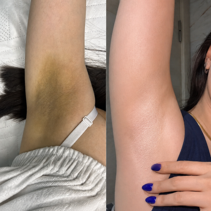 Yasmin's underarm before and after