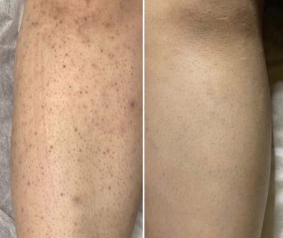Priya's calves before and after