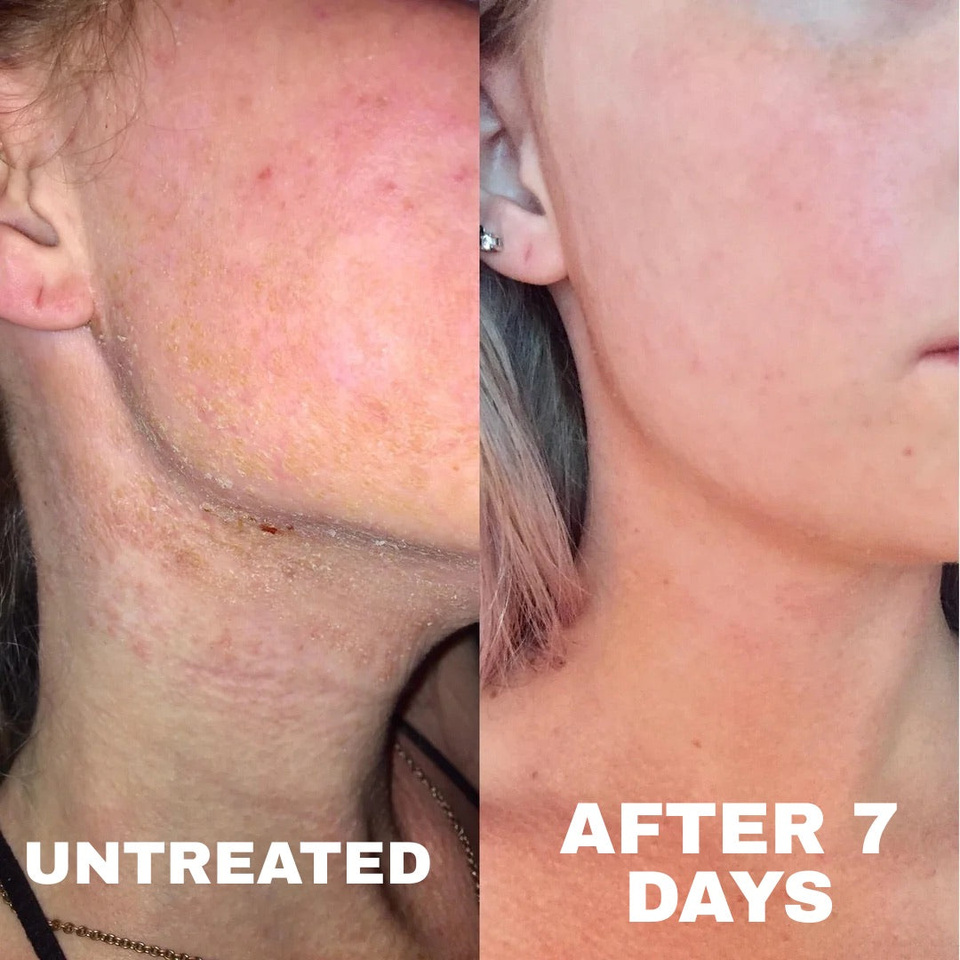 Eczema before and after