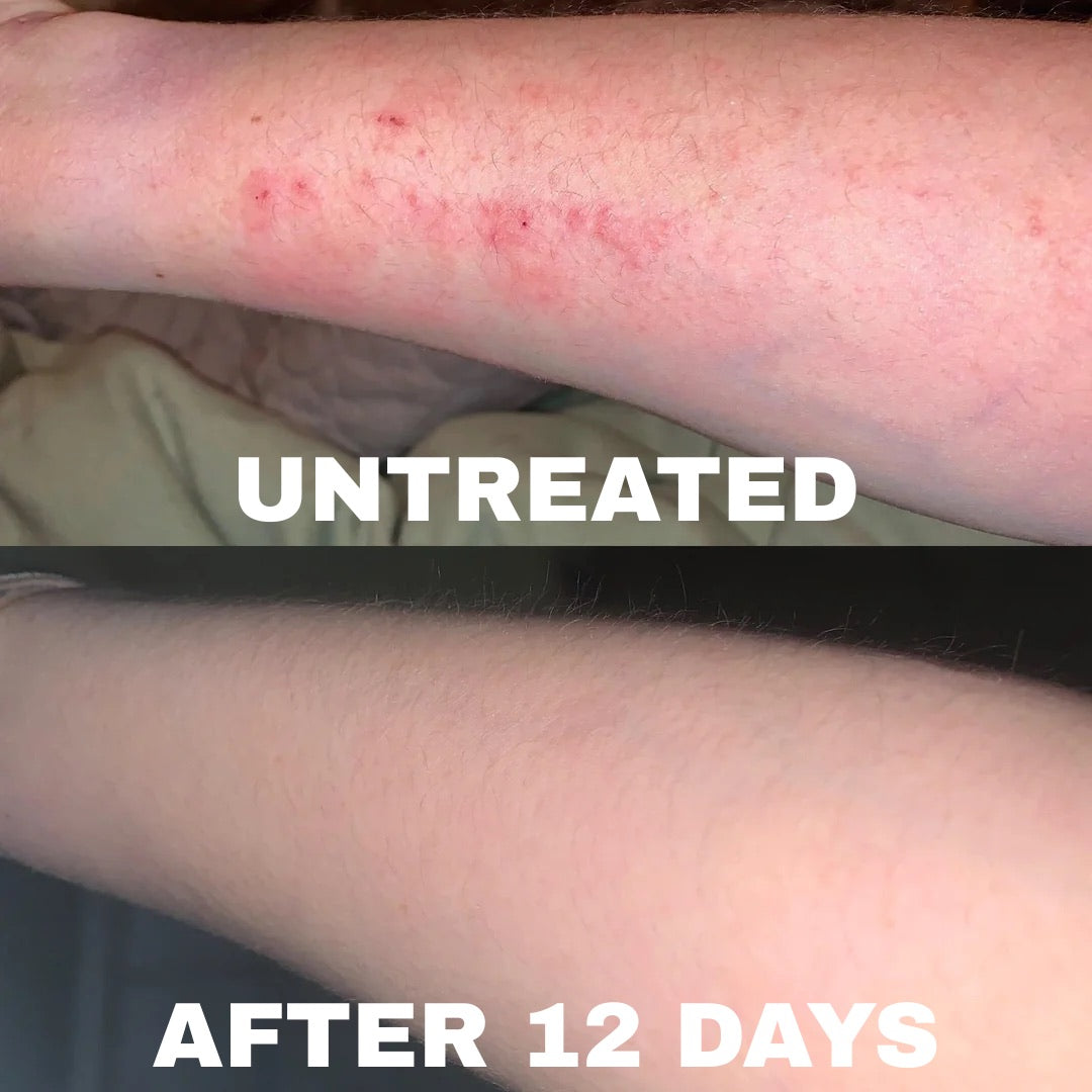 Eczema arm before and after