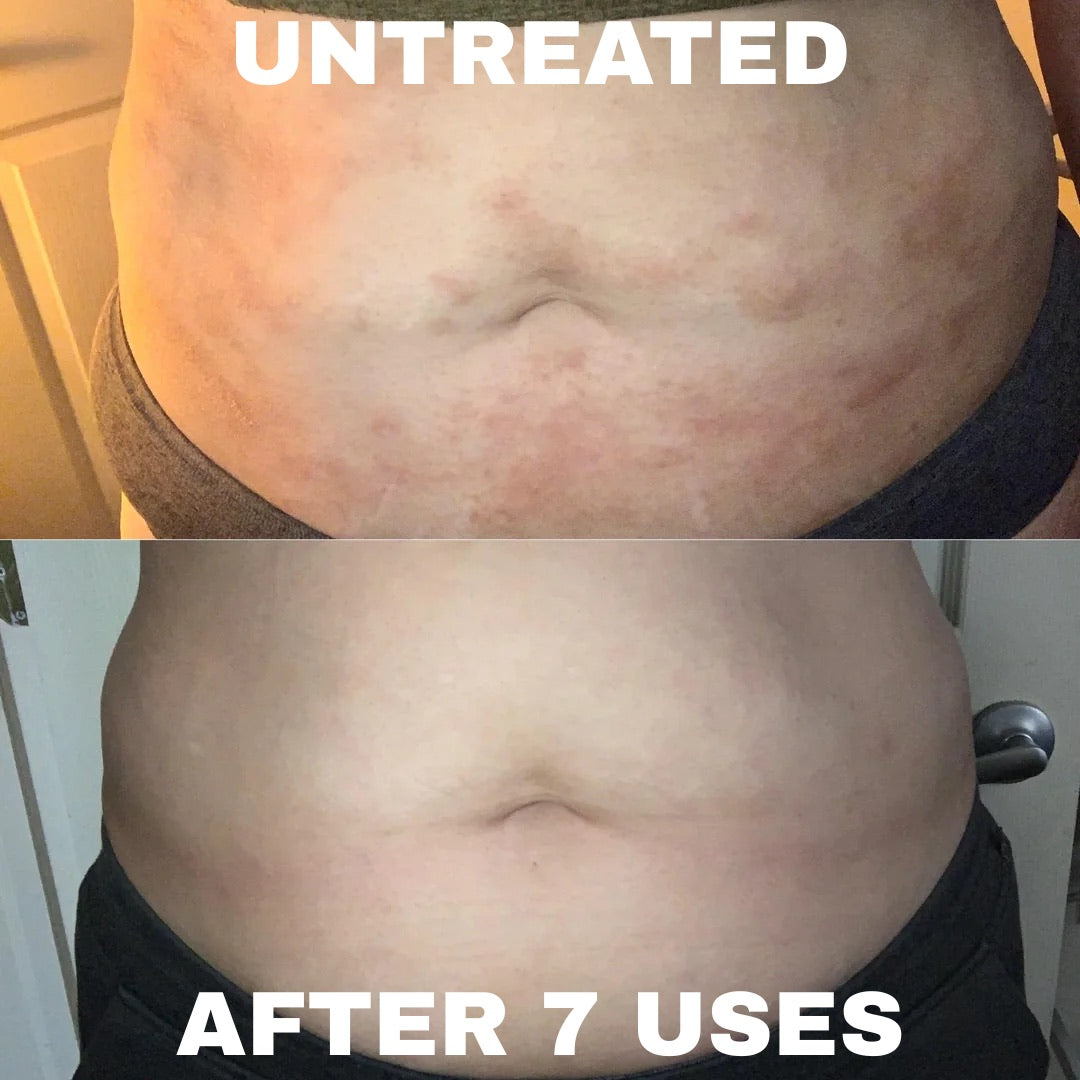 Eczema before and after