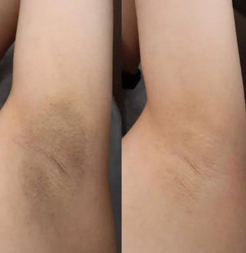 Before and after: underarm brightening