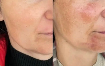 Before and after: facial discoloration faded