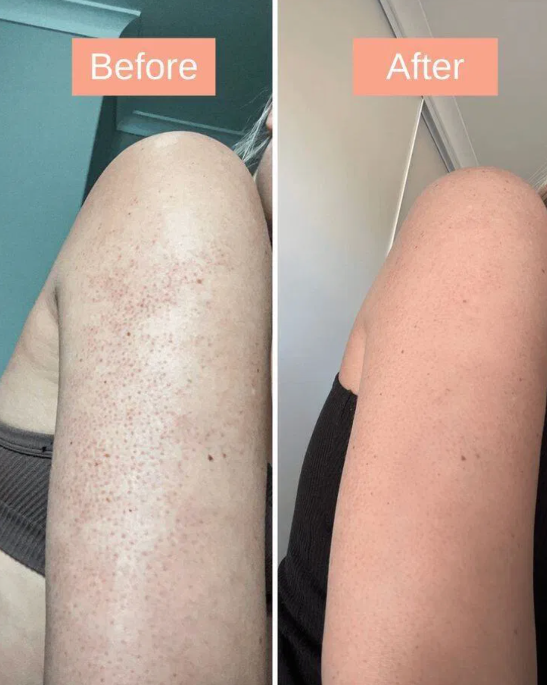 Veda's arm before and after, bumps and redness cleared