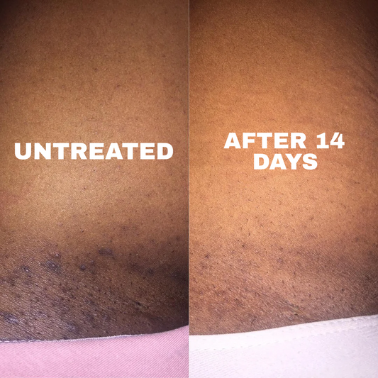 Hyperpigmentation in Darker Skin: What to Know