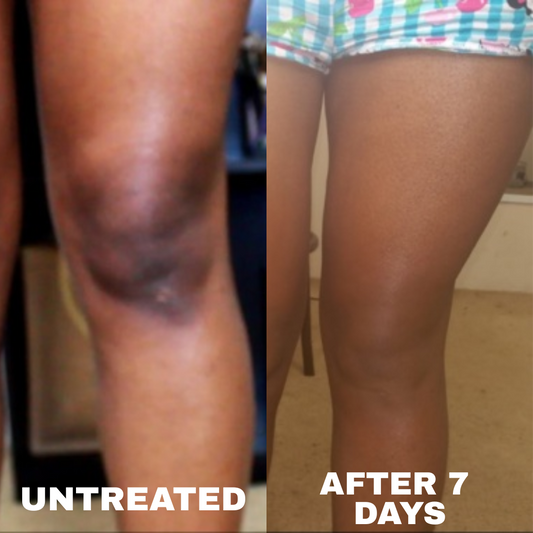 Hormonal Changes &amp; Hyperpigmentation Explain