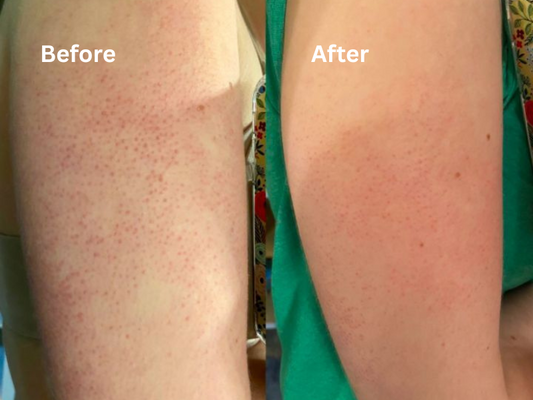 Can You Recognize Keratosis Pilaris at Home?