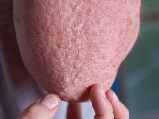 The Skin Barrier's Role in Eczema (and How to Repair It)
