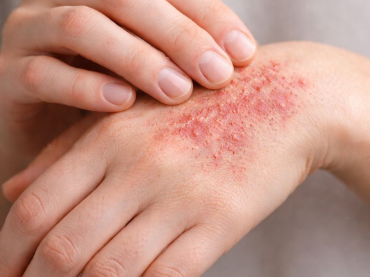 The Most Common Eczema Symptoms