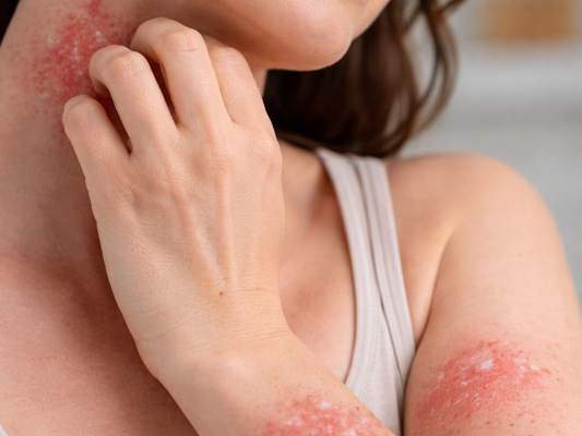 A Guide to Adult-Onset Eczema