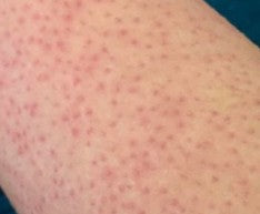 Hormonal Changes and Keratosis Pilaris: Why Bumps Flare or Fade