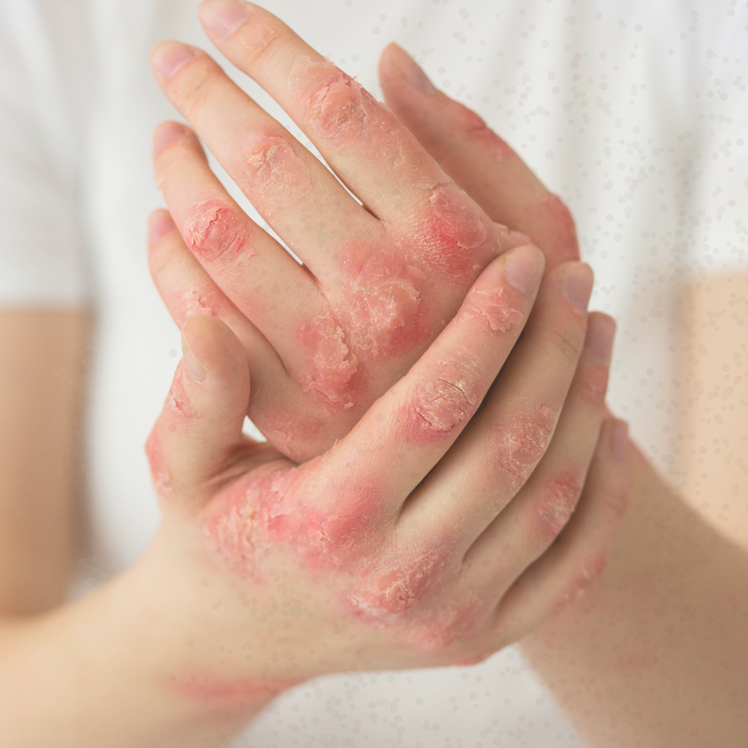 Stress &amp; Eczema: How Stress Triggers Flare-Ups (and What Helps)