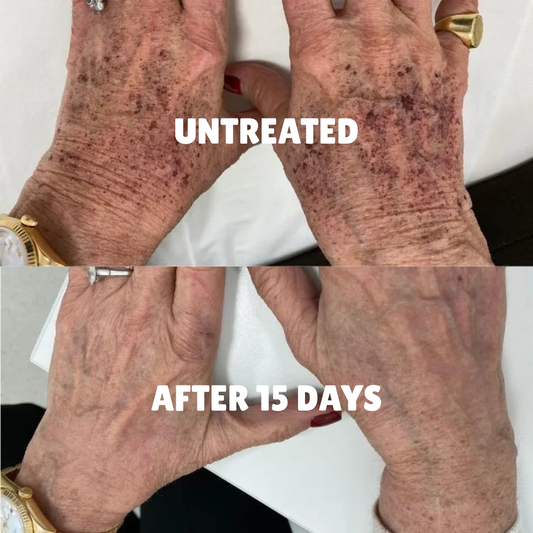 Retinoids for Dark Spots & Pigmentation