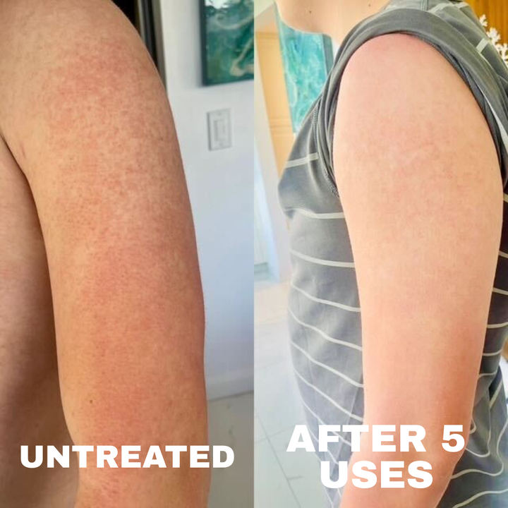 Types of Keratosis Pilaris: Which One Do You Have?