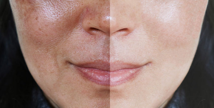 Vitamin C Serums for Hyperpigmentation
