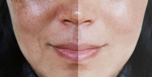 Vitamin C Serums for Hyperpigmentation