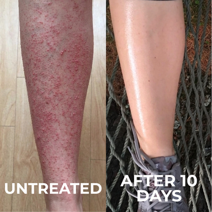 Advanced Triple-Acid Complex for Keratosis Pilaris FB