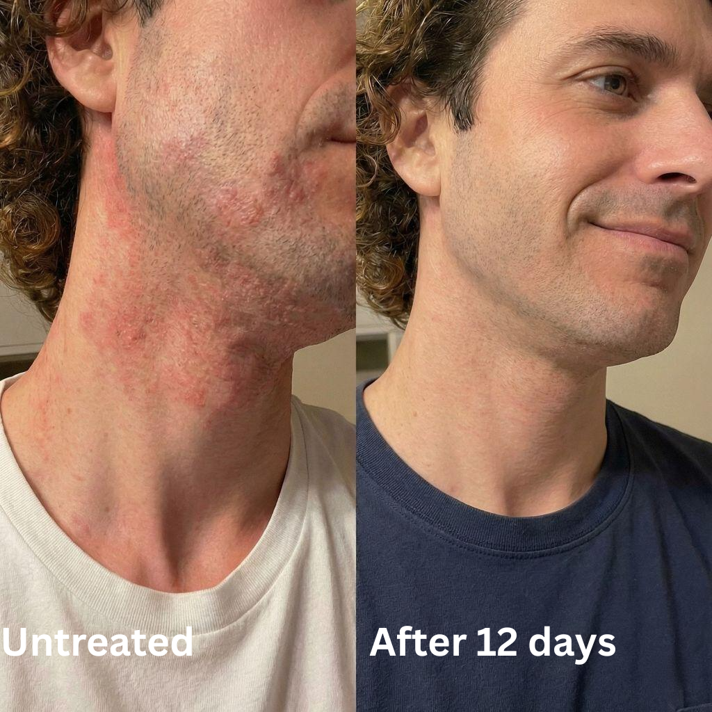 Advanced Barrier Repair Complex for Eczema (Copy)