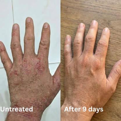 Advanced Barrier Repair Complex for Eczema (Copy)