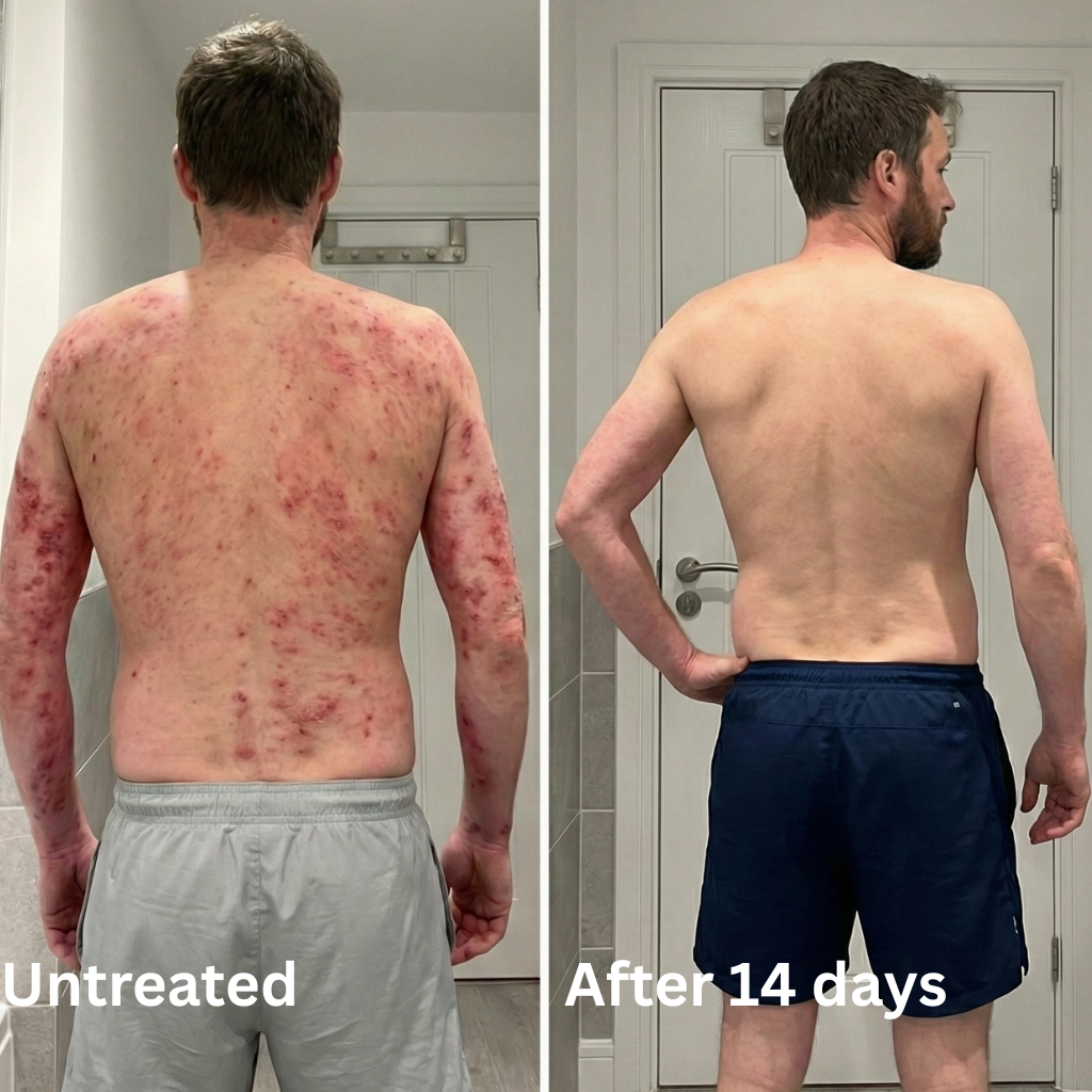 Advanced Barrier Repair Complex for Eczema (Copy)