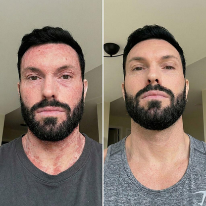 Advanced Barrier Repair Complex for Eczema (Copy)