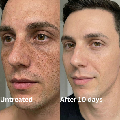 Advanced Triple-Acid Complex for Hyperpigmentation (Copy)