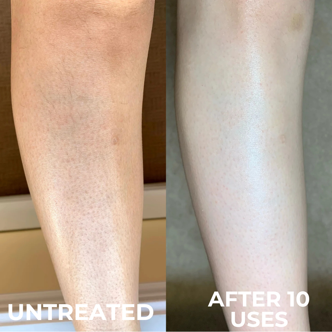 Advanced Triple-Acid Complex for Keratosis Pilaris showing skin improvement after 10 uses.