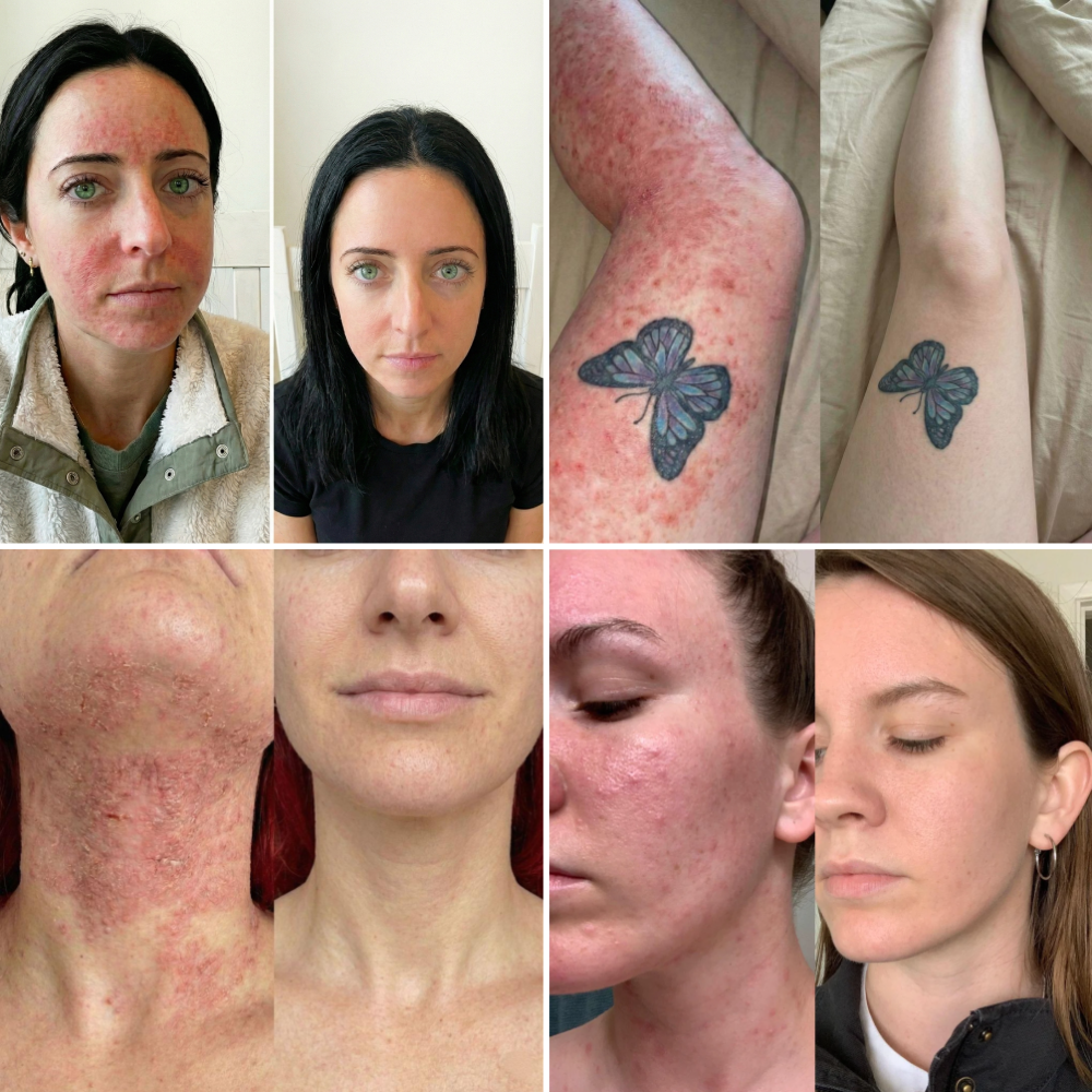 Four before and after pairs: two faces, a neck and a knee cleared of eczema
