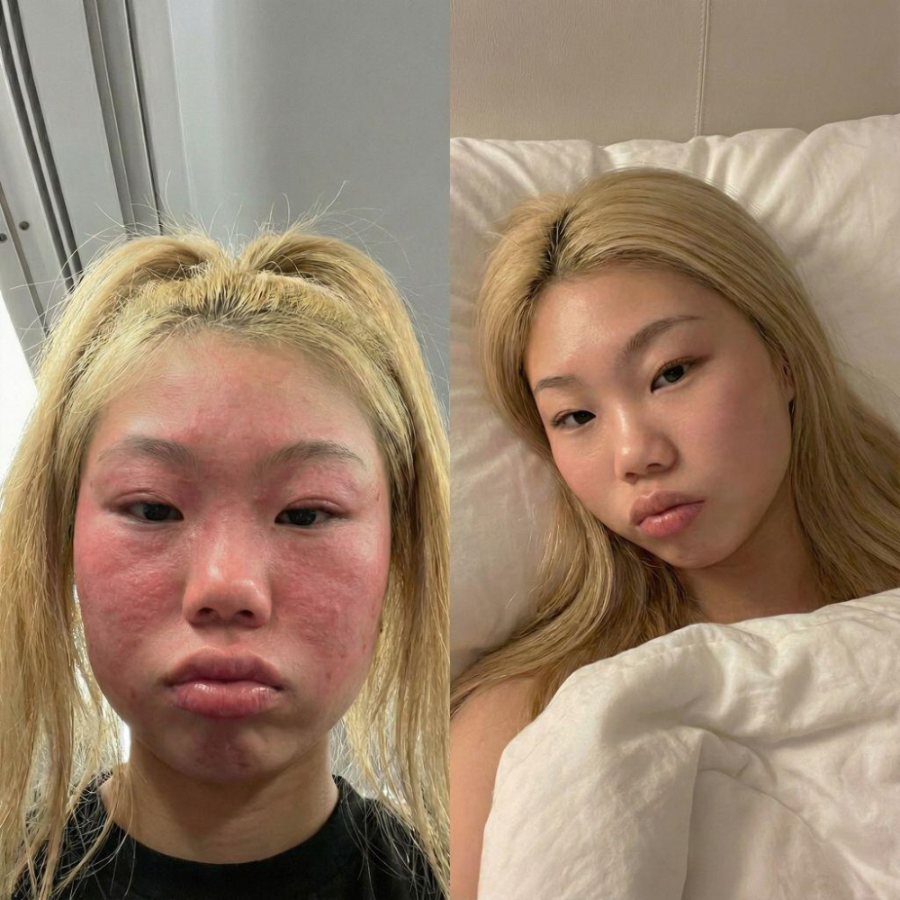 A woman's face raw, red and swollen with an eczema flare, then calm and clear after one week